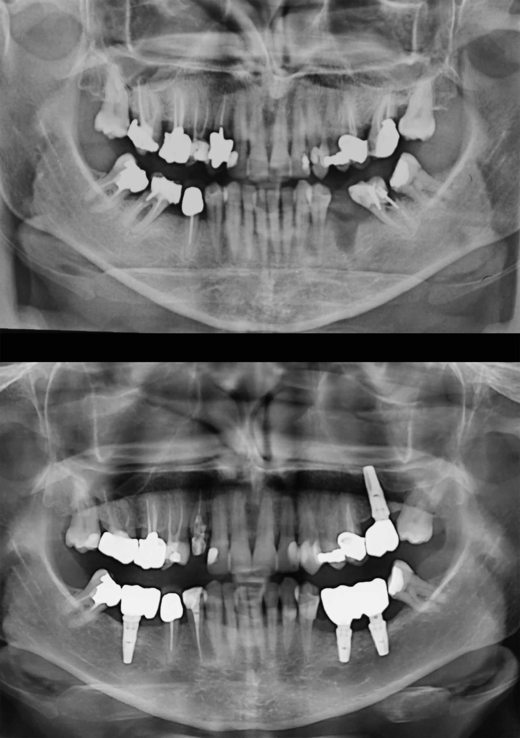 Trattamento_implantologia