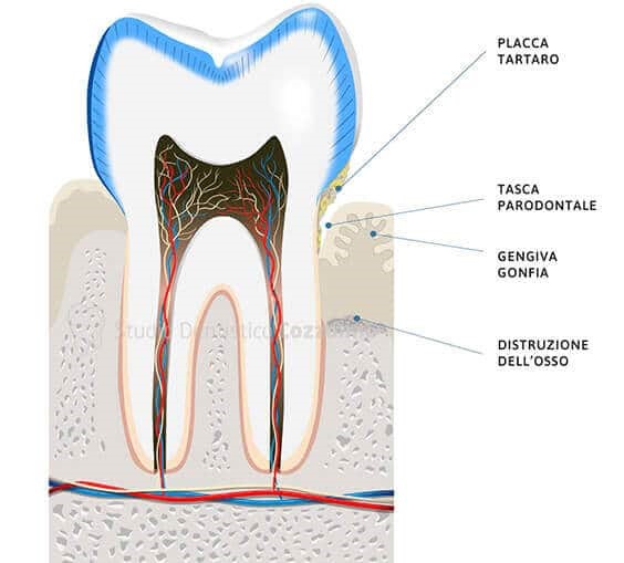 parodontite