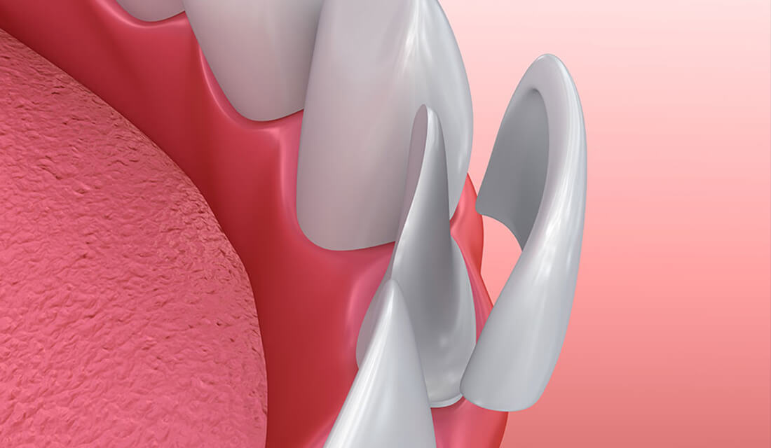 protesi_faccette_estetiche
